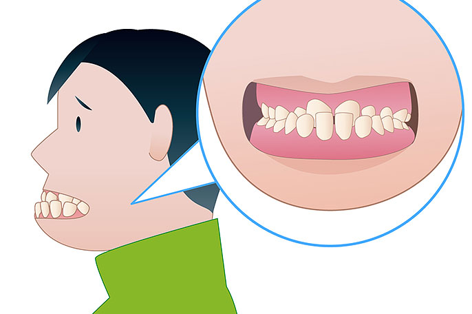 反対咬合の治療方法